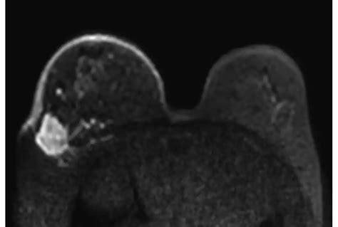 Philips - Diffusion - Breast MR clinical application