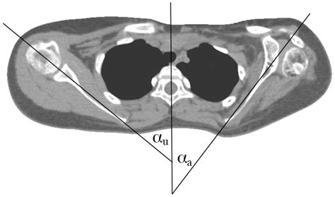 Reduced Clavicle Length Indicates the Severity of Scapular Misalignment ...