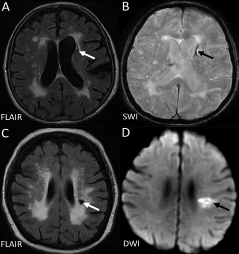 Mild Microvascular Ischemic Disease - Captions Quotes