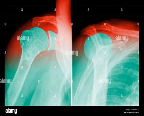 Inferior Shoulder Dislocation X Ray at Jeff Updike blog