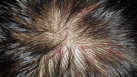 Bumps and Spots on Scalp: Unveiling the Mystery Behind Those Annoying Imperfections - How to Get ...