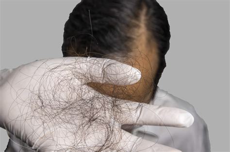 Does Wearing a Hat Cause Hair Loss?