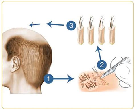 Hair Transplant - Cost, Techniques, Advantages & Procedure