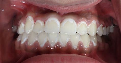 White Spots on Teeth from Braces – Frisco Orthodontist Warns