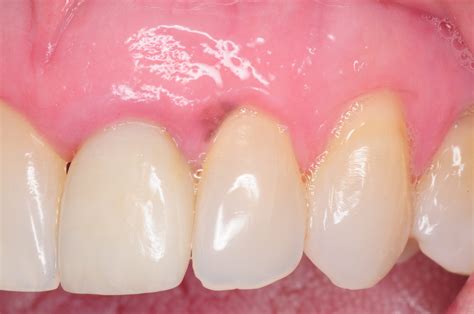 Pigmented (Purple or Brown) Lesions in the Mouth | Pigmented (Purple or ...