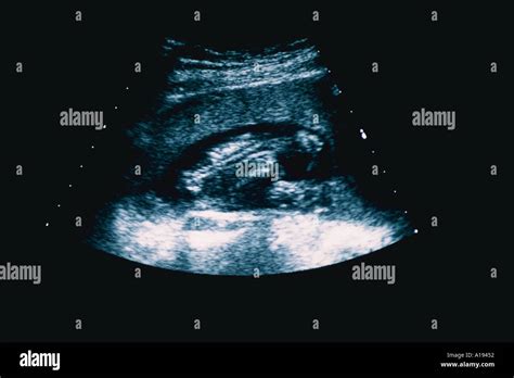 Ultrasound 的图像结果