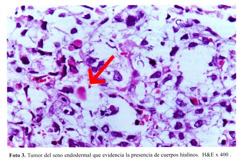 Tumor Do Saco Vitelino Corpos De Schiller Duval Shuller Duval Bodies