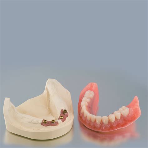 Implant Over Denture in Christchurch | Secure Fit