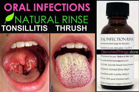 Creams For Oral Thrush at Alan Darlington blog