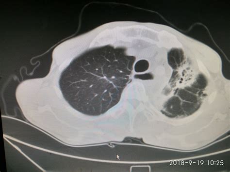 肺结核的x线影像特征,影像学,表现_大山谷图库