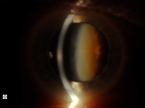 Kuvatulokset haulle cataract