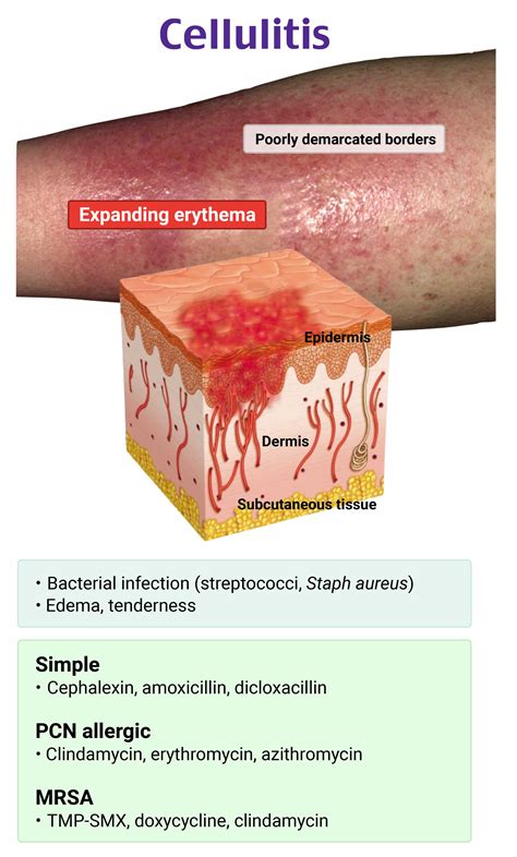 Is Cellulitis Spreadable