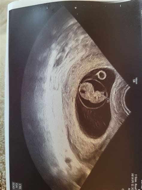 Almost 9 week ultrasound | BabyCenter