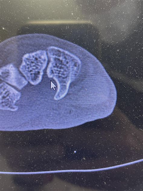 Hook of Hamate (hand bone) fracture - trail hand : r/golf