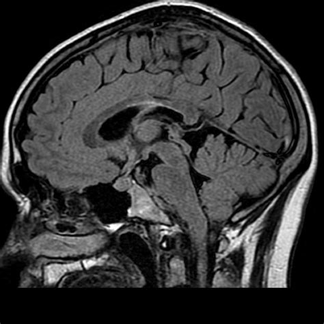 Dot-Dash sign - Medicine Question Bank