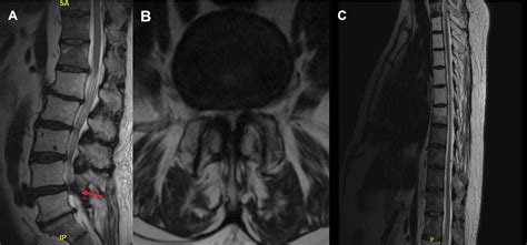 Diffuse mets to spine with lumbar stenosis - Clinical Tree