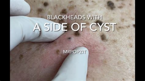 Image result for Largest Infected Exploding Cyst Carbuncle Blackhead