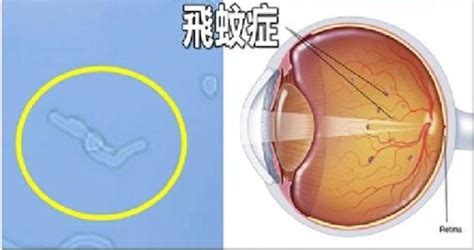 眼科 - 飞蚊症治疗 - 复禾健康