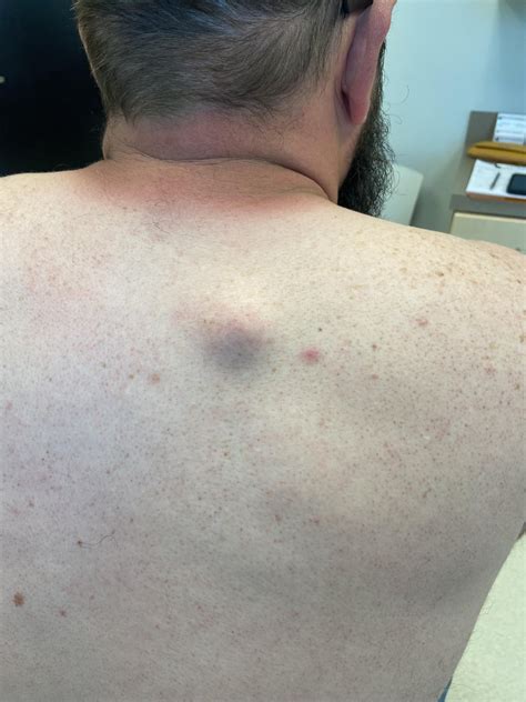 Image result for Sebaceous Cyst On Back