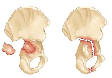 Acetabular Fractures - OrthoInfo - AAOS