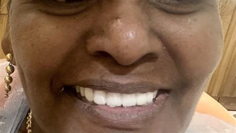 Affordable Full Mouth Dental Implants Cost in India - Book Your ...
