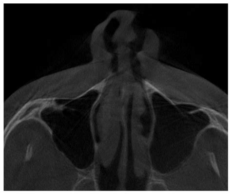 The CBCT Retrospective Study on Underwood Septa and Their Related ...