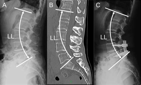 Does vacuum phenomenon at non-fused discs affect the postoperative ...