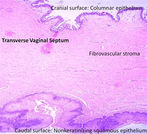 Transverse vaginal septum | Dr Roshan Nasimudeen
