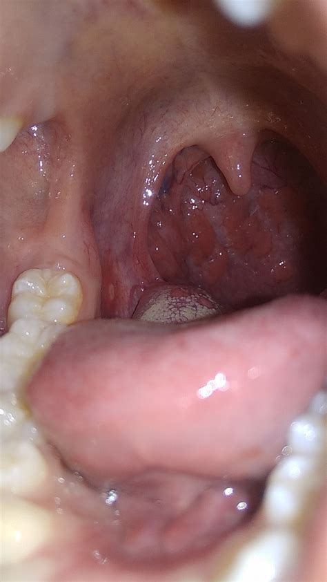Canker Sore On Tonsils