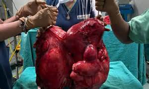 18.5kg Fibroid Uterus Tumour Removed from Woman at BLK-Max Super ...