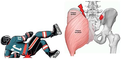 Posterior Hip Pointer: Subperiosteal Detachment of the Gluteal Muscles ...