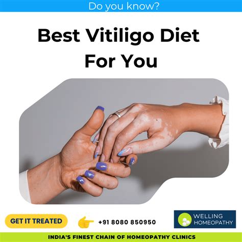 Comprehensive Guide On Foods To Eat & Avoid With Vitiligo Diet