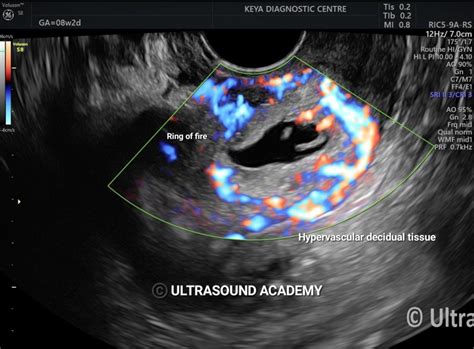 CERVICAL ECTOPIC PREGNANCY – Case By Dr. Nitin Jadhav