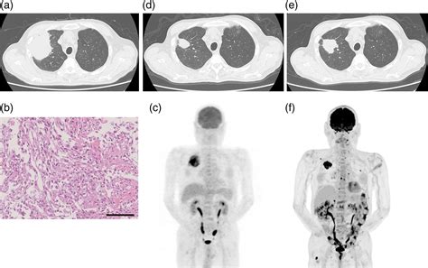 TIM‐3 expression induces resistance to PD‐1 inhibitor in G‐CSF‐producing lung spindle cell ...