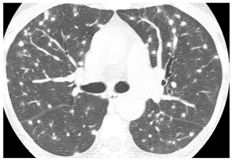 Imaging Findings of Lung Nodule or Mass | Encyclopedia MDPI