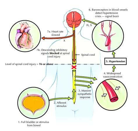 Rehabilitation medicine: 1. Autonomic dysreflexia | CMAJ