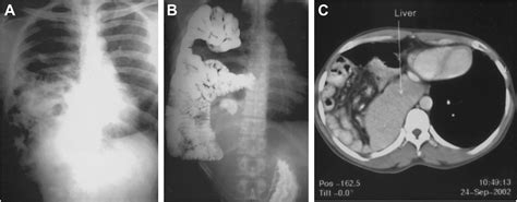 Congenital Hernias in Adults - Thoracic Surgery Clinics