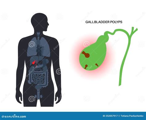 Gallbladder Polyp Ayurveda Treatment at Martha Holt blog