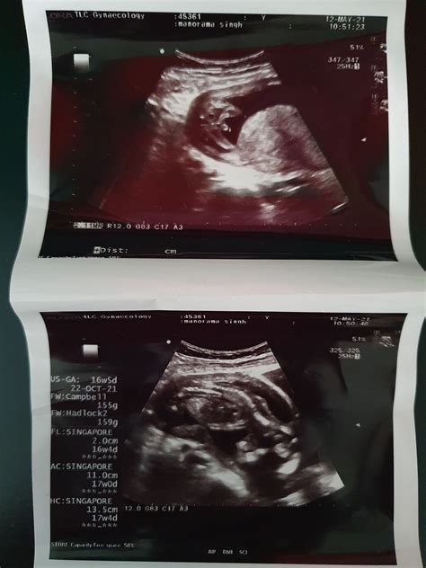 Its A Girl Ultrasound 16 Weeks