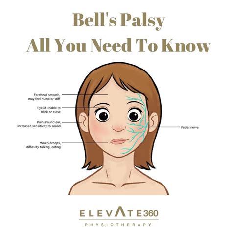 Bell's Palsy Vs Stroke - Bell S Palsy All You Need To Know Elevate Physiotherapy - They can look ...
