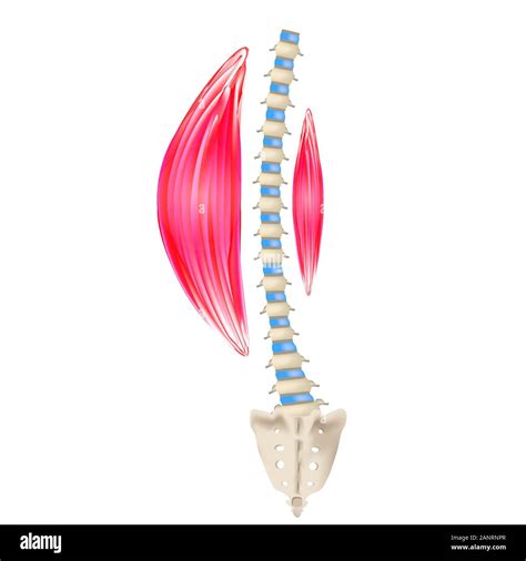 Left-sided scoliosis. Levoscoliosis. Muscles and spine. Spinal curvature in scoliosis ...