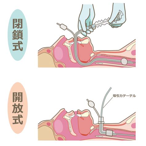 閉鎖式気管吸引と開放式気管吸引のイラスト🎨【フリー素材】｜看護roo![カンゴルー]