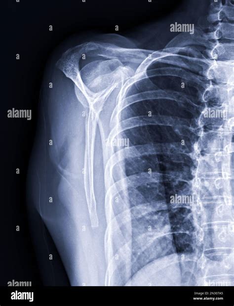 X-ray Shoulder joint shoulder transcapular view for diagnosis fracture ...