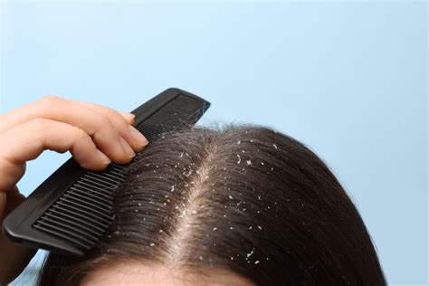 Brushing Hair 101: How To Comb Your Hair During Dandruff | Head ...