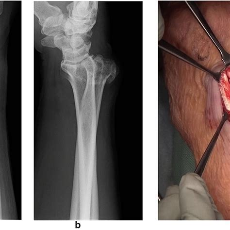 Image result for Extensor Digitorum Communis Surgery