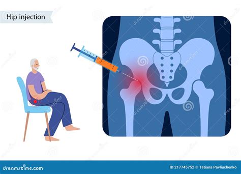 Cortisone Injection Hip