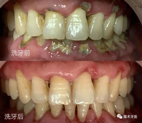 牙周炎，中国成年人后半生永远的痛