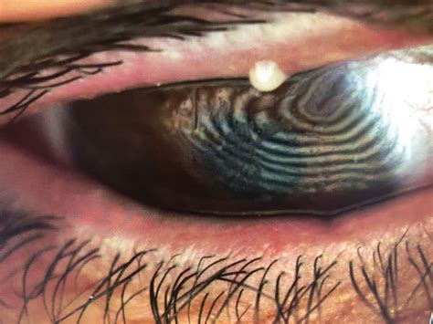 Meibomian Gland Cyst