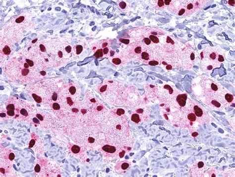 Pathology Outlines - Granular cell tumor