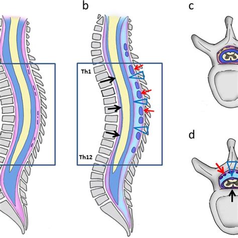 Illustration of disc-osteophyte complex size measurement. | Download ...